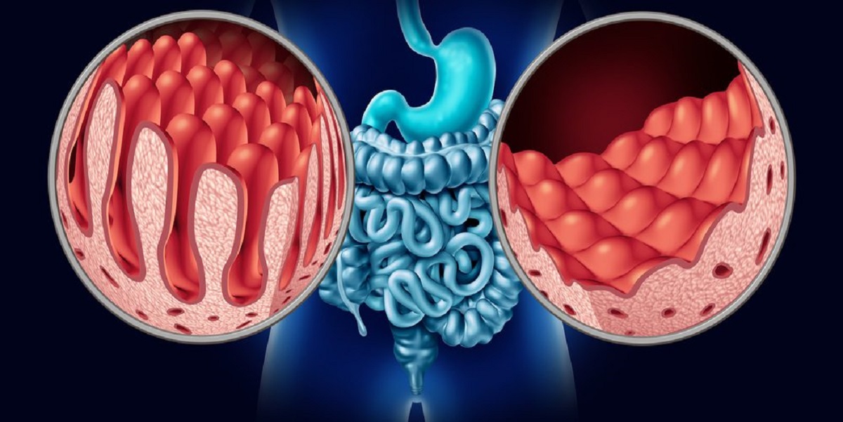 Medical Device News: Cambridge-based-firm-receives-US-240k-funding-for-coeliac-research