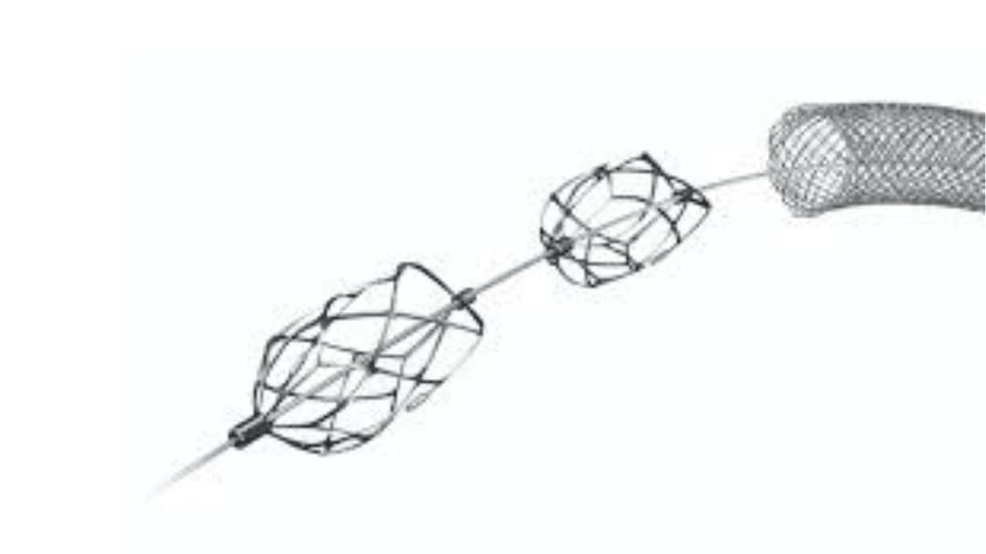Endologix acquires Pounce thrombectomy system from Surmodics