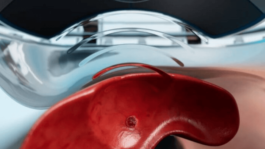 HistoSonics closes new financing with value reaching $3.75B