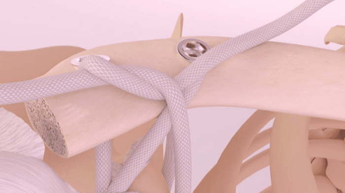 Movmedix gets FDA nod for third-gen synthetic shoulder implant