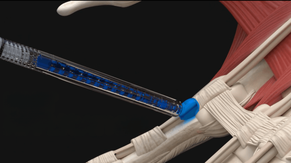 TYBR Health raises $30M Series A to expand orthopedic hydrogel platform