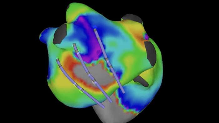 CoreMap raises $37M Series C led by Medtronic to advance AFib mapping technology