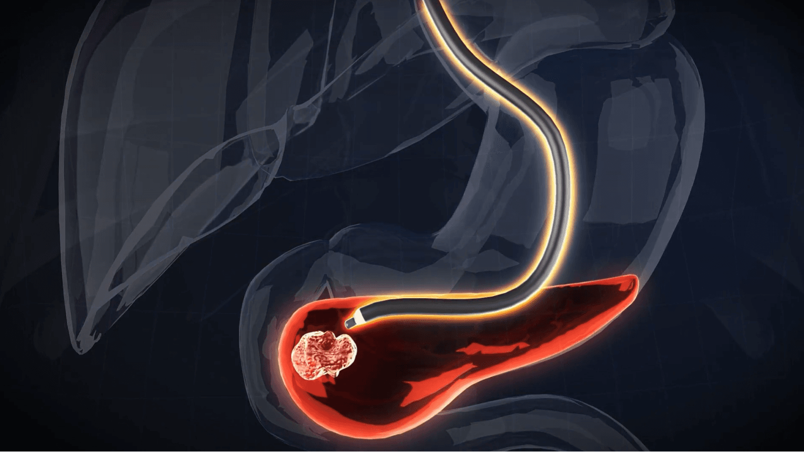 OncoSil wins FDA humanitarian exemption for bile duct cancer device