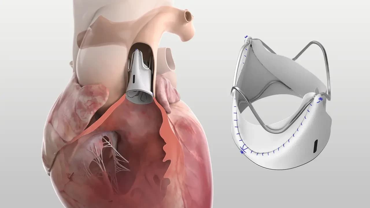 FDA approves Edwards' Autus, the first Heart Valve designed to grow with children