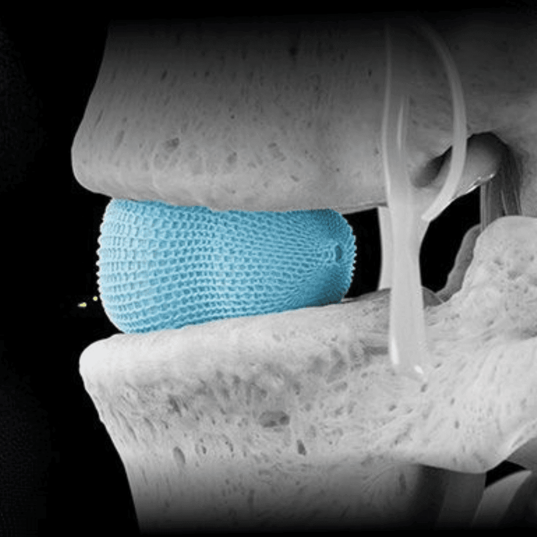 Spineology launches innovative patient-specific spinal implant