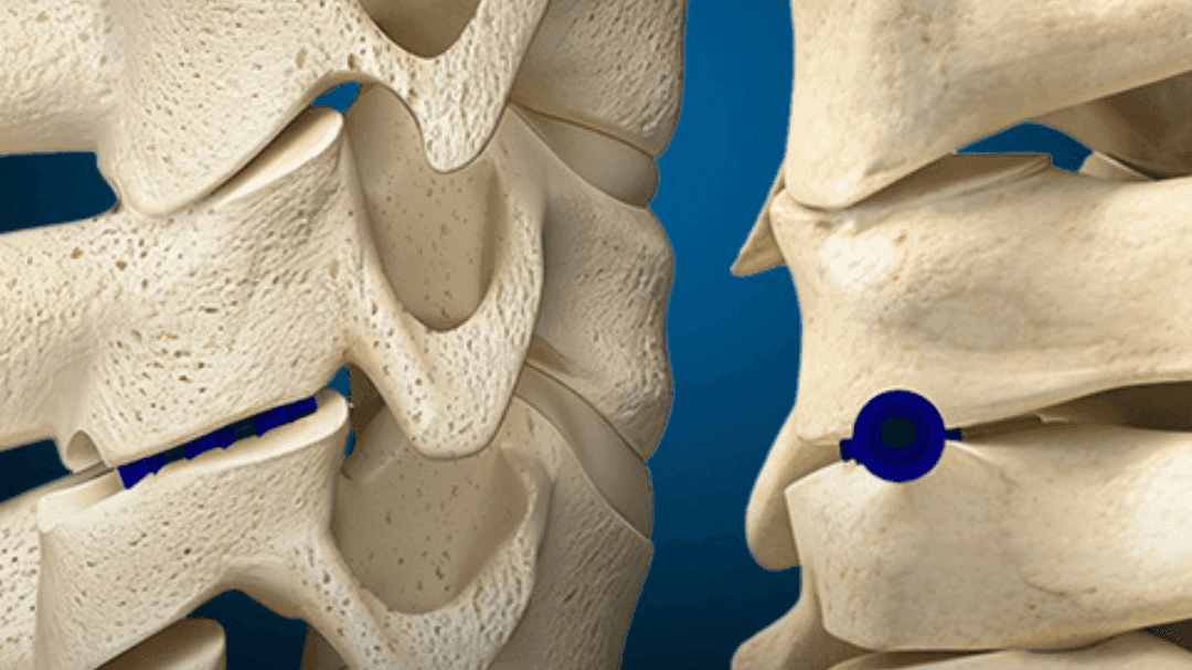 SurGenTec gets FDA nod for lumbar facet fixation system