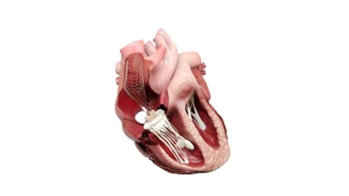 CroíValve closes $36M expanded Series B financing for tricuspidTR