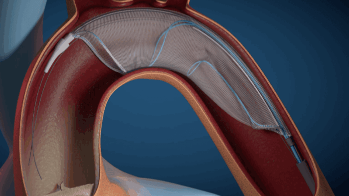 AorticLab earns expanded CE mark for embolic protection device