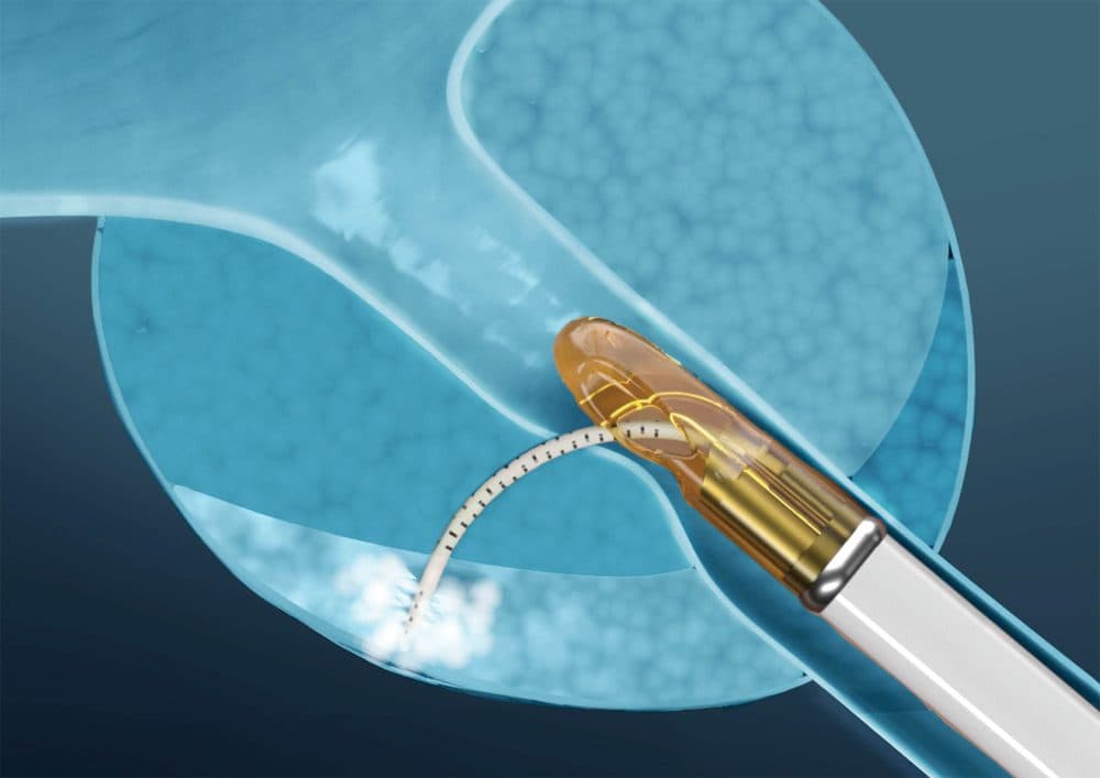 Francis Medical announces publication of VAPOR 2 pivotal trial results