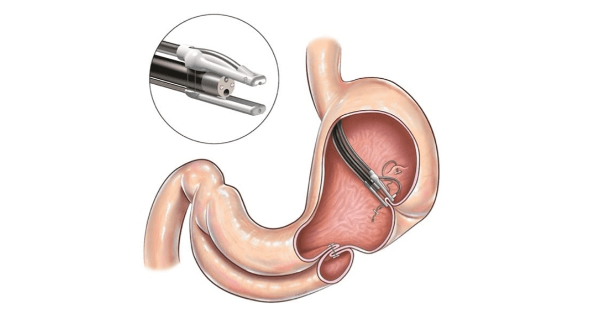 Endo Tools Therapeutics raises $23M Series C to expand endomina platform