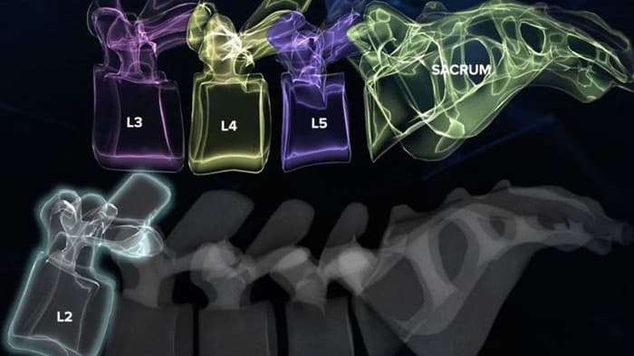 VB Spine completes acquisition of Augmedics' CT-to-fluoroscopy navigation technology