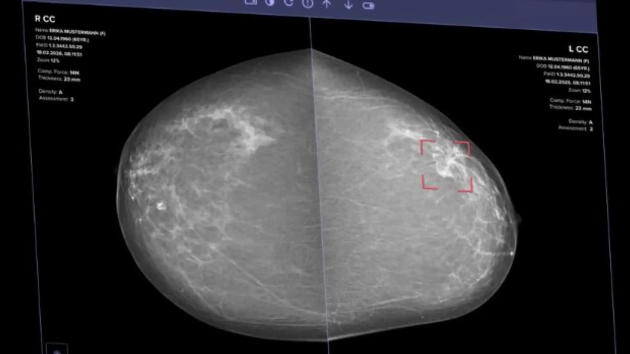 Vara wins first CE mark for autonomous AI mammogram reporting