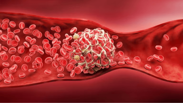 Anaconda Biomed stroke catheter