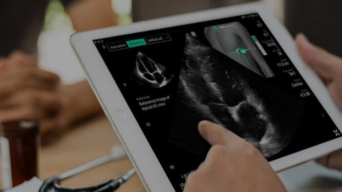UltraSight AI-guided cardiac ultrasound
