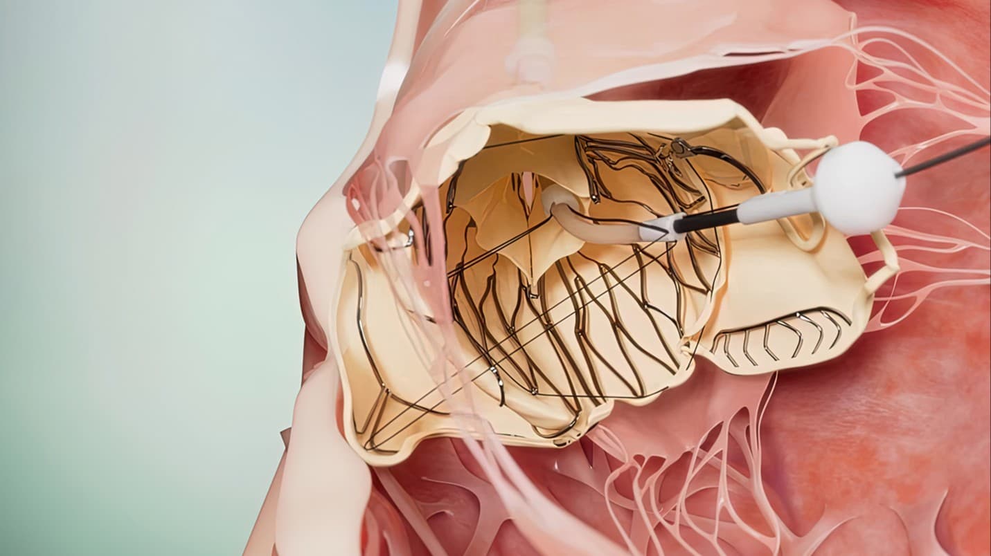 Laplace treats first patients in TRIUMPH pivotal trial of Tricuspid Valve